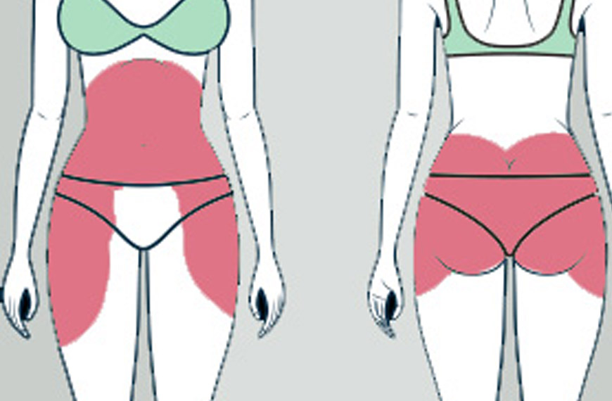 Lipocavitation et radiofréquence, dites stop à la cellulite ! - Du poids à  la ligne