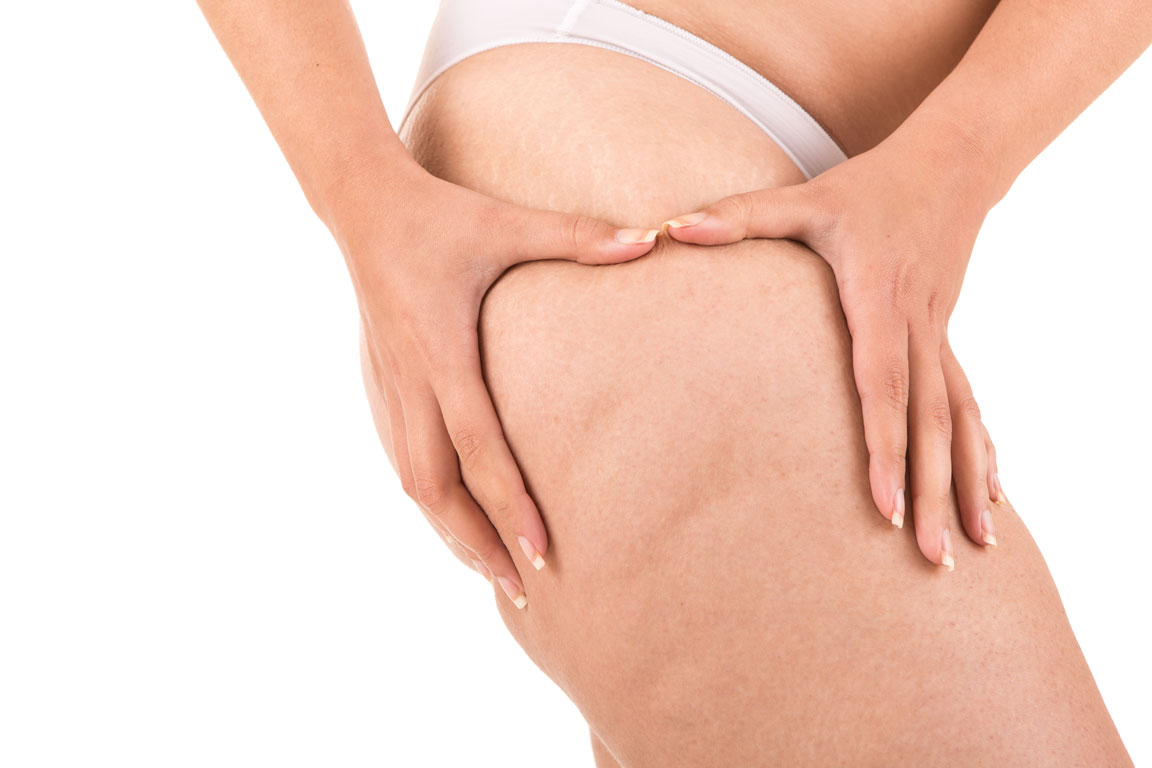 cellulite-traitement-dupoidsalaligne