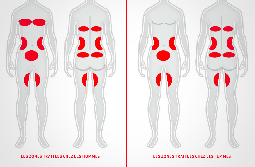 Les zones traitées Cryolipolyse C8